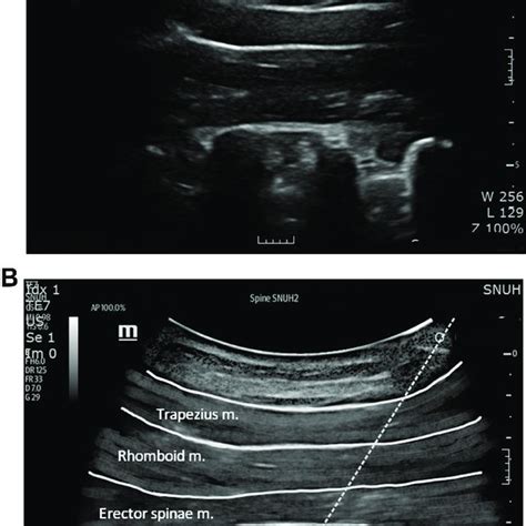 Ultrasound Guided Thoracic Paravertebral Block In A Sagittal Image