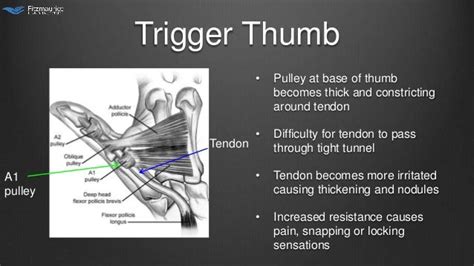 Endo View™ Trigger Thumb