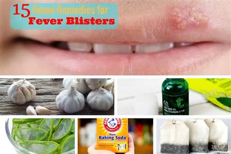 15 Home Remedies For Fever Blisters