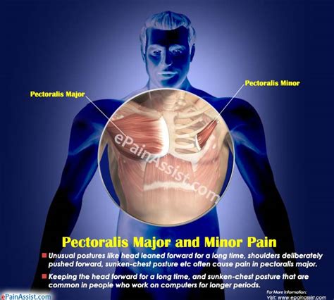 The most frequently observed variation was a separate clavicular portion of the pm. Pectoralis Major and Minor Pain|Causes|Symptoms|Treatment ...