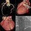 Unusual Trifurcation Of A Single Left Coronary Artery  BMJ Case Reports