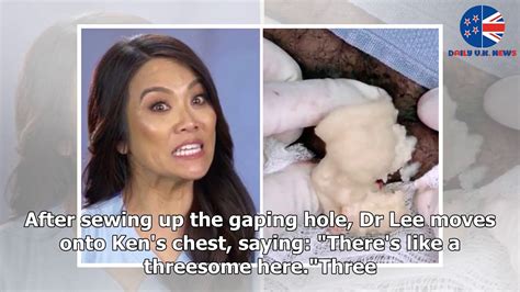 Dr Pimple Popper Squeezes Foul Smelling Rainbow Cyst Biggest I Ve Ever Seen Youtube
