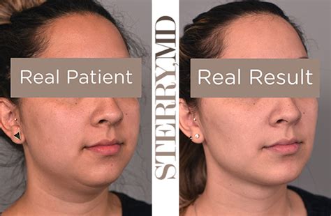 Cheek Liposuction And Buccal Fat Removal Reduce Chubby Face In Nyc