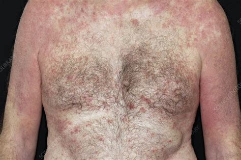 Eczema On The Torso Stock Image C0051842 Science Photo Library