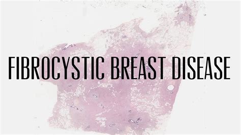 32 Fibrocystic Breast Disease Youtube