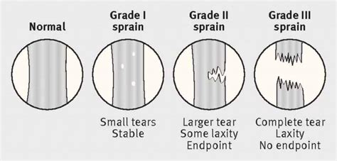 The Complete Guide To An Mcl Tear Kinetic Labs