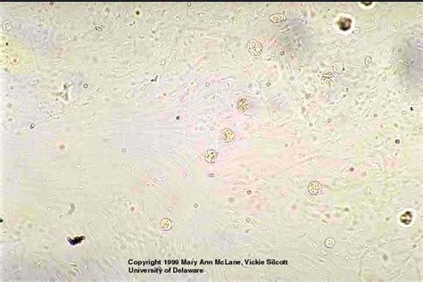 Bacteria Mucus And White Blood Cells In Urine Sediment Medical