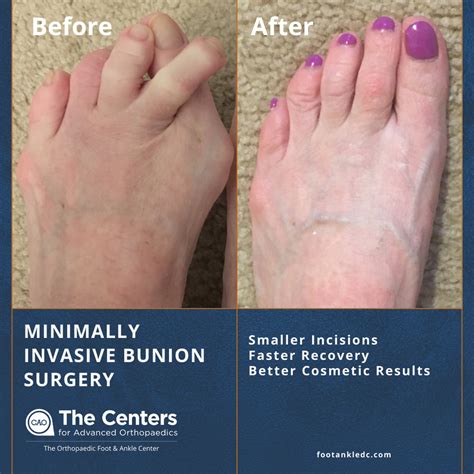 Minimally Invasive Bunion Surgery