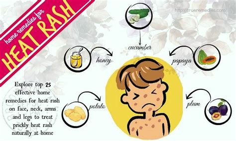 25 Home Remedies For Heat Rash On Face Neck Arms And Legs