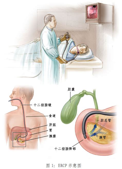 我院成功开展经内镜下逆行性胰胆管造影术（ercp） 重庆医科大学附属大学城医院