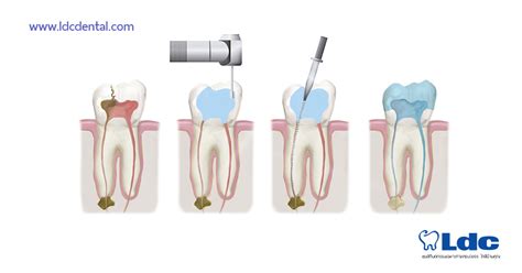 การรักษารากฟัน - patiphonsite