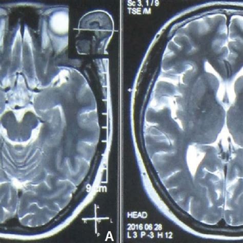 Brain Magnetic Resonance Imaging Mri At Disease Onset No Remarkable