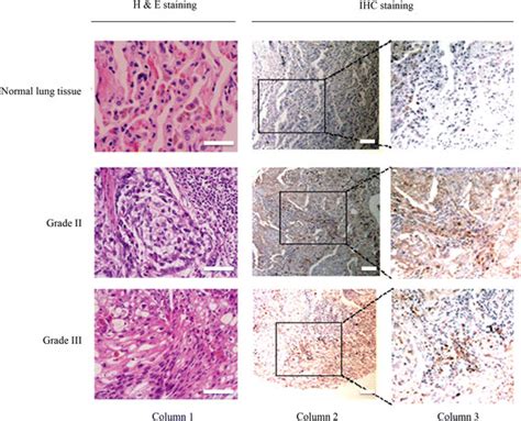 Cip2a Expression In Normal Lung Tissue And Lung Cancer Tissue By