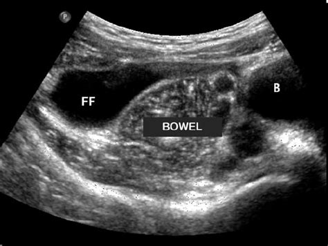 Ultrasound Of Abdomen Demonstrating Free Fluid Marked Ff Download