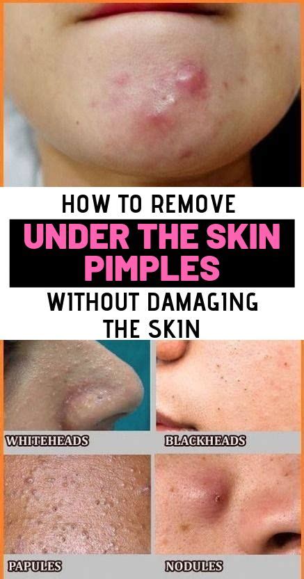 A Parasitic Pimple Means Acne That Has Developed Underneath Your Skin