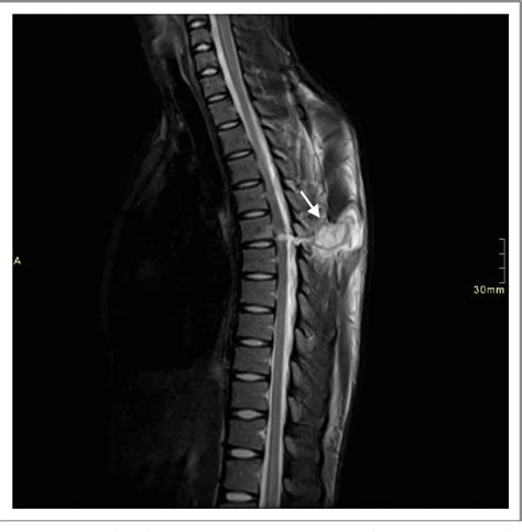 Figure 4 From Imaging Findings Of Penetrating Spinal Cord Injuries