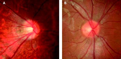 Corneal Biomechanics Thickness And Optic Disc Morphology In Children