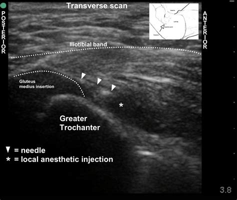 Muscular pain that comes on suddenly in your lower back is often indicative of a muscle spasm. US-Greater trochanter injection vs standard ED care: a thought experiment — Highland EM ...