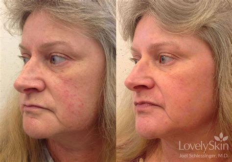 Rosacea Before And After Photos Skin Specialists Pc