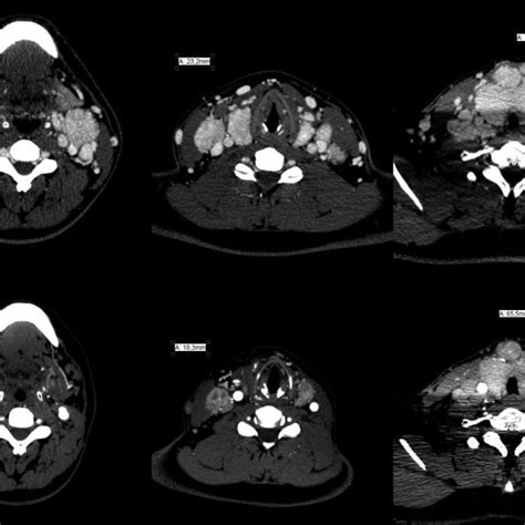A Initial Ct Scans Revealing Thyroid Enlargement With Tracheal