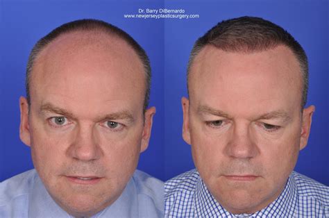 Smartgraft Hair Transplant Before And After Photos Patient 36 Houston