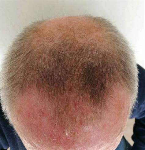 Male Pattern Baldness Is A Condition That Causes A Receding Hairline
