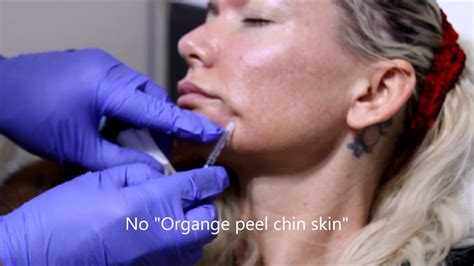 Botox Injections In Chin Improves Orange Peel Chin Skin Youtube