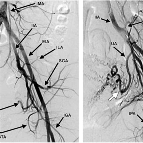 Pelvic Arterial Anatomy Angiogram Human Anatomy
