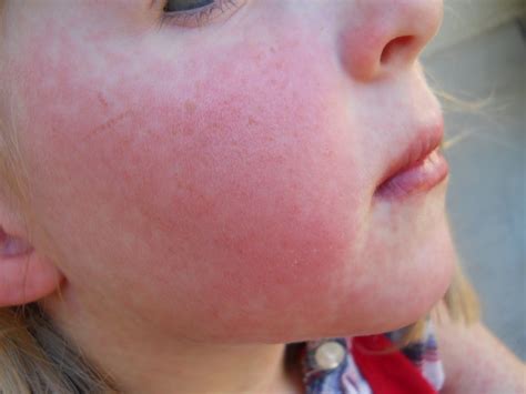 Strep Rash On Face Pictures Photos