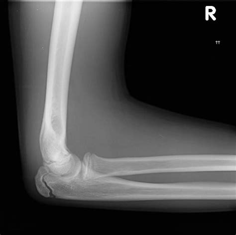 Splinter Series A Pain In The Elbow Laptrinhx News
