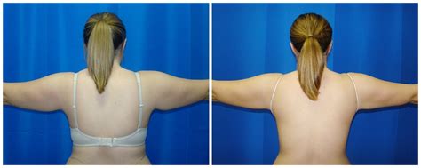 Patient 206 Female Liposuction Before And After Photos Katy Plastic