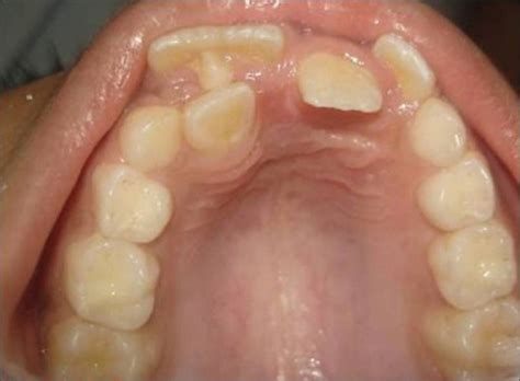 Talon Cusp On The Palatal Surface Of Affected Tooth Download