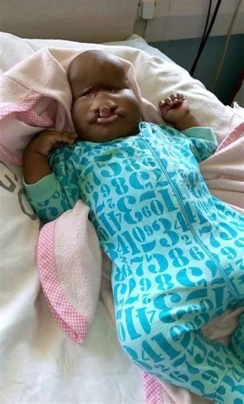Parents Reject Newborn With Facial Deformities Call Her An Alien