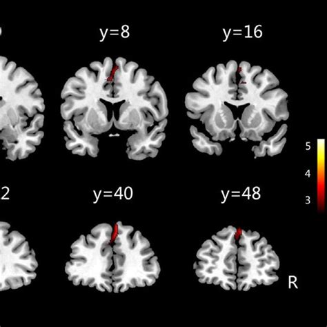 A Increased Gray Matter Volumes In Children With Pmne Compared With