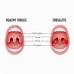 Strep Throat Signs In Adults Without Tonsils