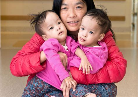 Conjoined Bhutanese Twins Undergo Separation Surgery Asia Health News