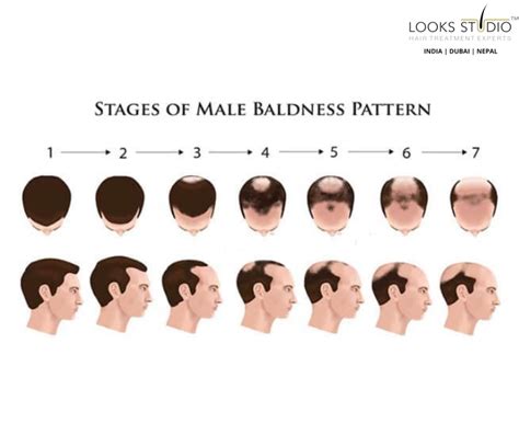 Understanding The Stages Of Baldness A Comprehensive Guide Hair