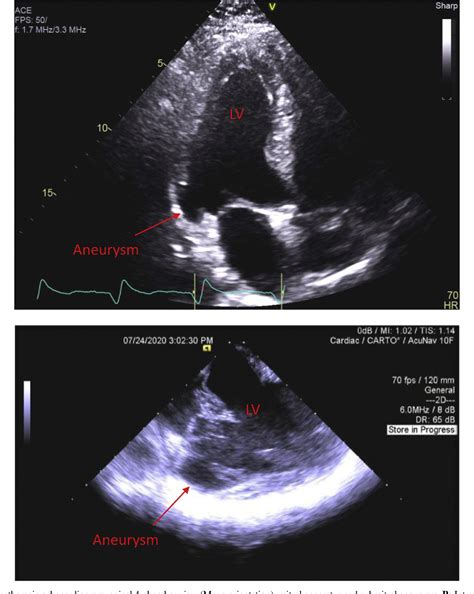 Figure 1 From Submitral Valve Aneurysm Ventricular Tachycardia