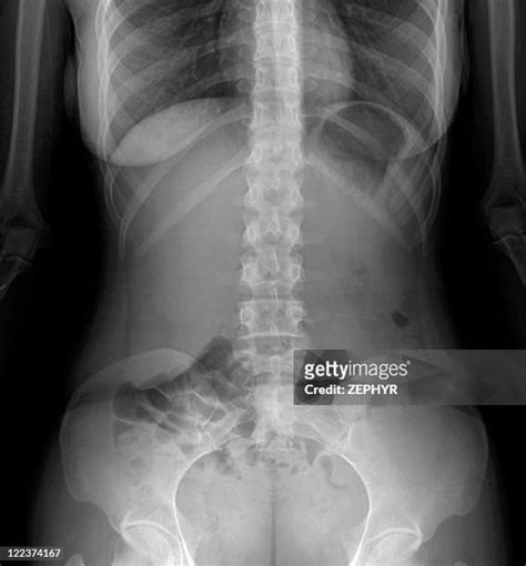 Normal Spine X Ray Photos And Premium High Res Pictures Getty Images