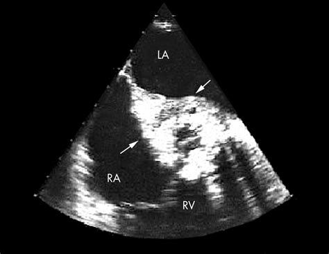 Echocardiography In Infective Endocarditis Heart