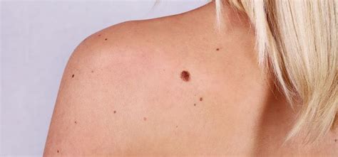 Skin Moles Screening In Boca Raton Fl Dermpartners