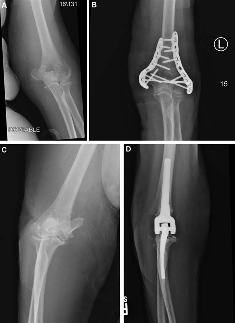 Long Term Outcomes Of Total Elbow Arthroplasty For Distal Humeral