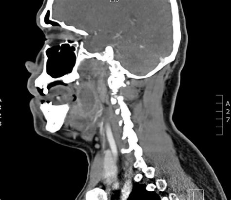 Sagittal Cut Of Contrasted Ct Scan Revealing Tosillar Abscess With Ring