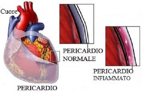 Lorsque le cœur se contracte, une partie du péricarde sécrète un liquide (dont la quantité varie entre 30 et 50 ml), qui agit comme un lubrifiant. Pericardite: sintomi, cause e trattamento - Vivere più sani