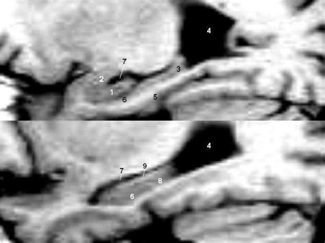 Sagital View Through Hippocampus On T Weigthed Mri Upper Image Is Download Scientific Diagram