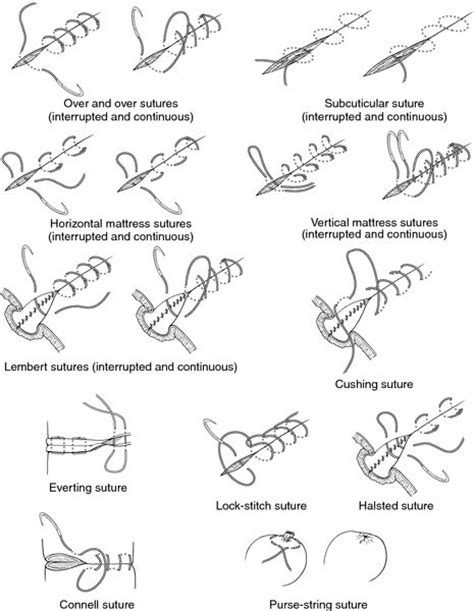 Surgical Sutures Different Types Of General Surgery And Stitches