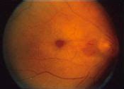 Cherry angiomas are bright cherry red, usually oval or circular, and small. Central retinal artery - wikidoc
