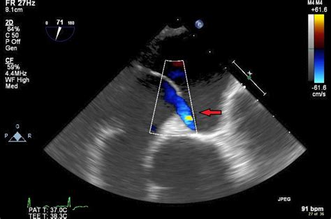 Cureus Patent Foramen Ovale With Platypnea Orthodeoxia Syndrome A