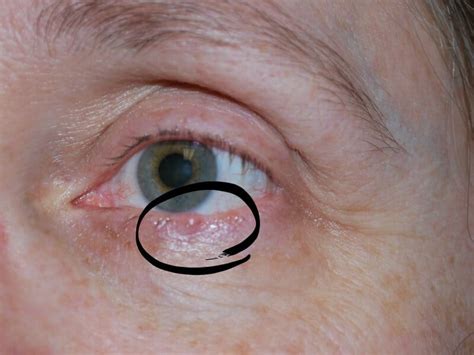 Early Basal Cell Carcinoma Eyelid