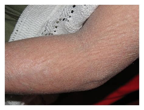 Dry Skin Of The Forearm Scaling And Dryness Are More Pronounced In The